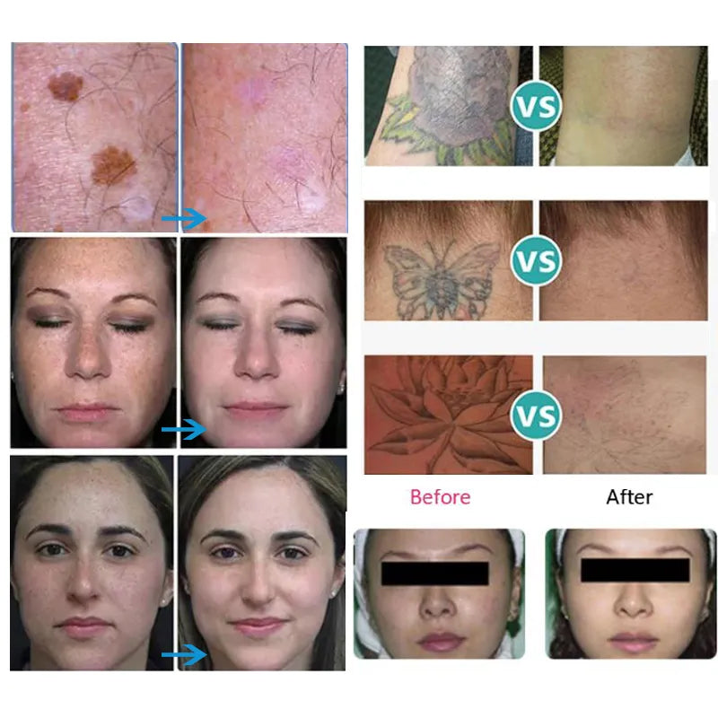 Nd YAG Picosecond Laser Tattoo Removal Machine Q Switch Pigment Freckle Removal Skin Rejuvenation